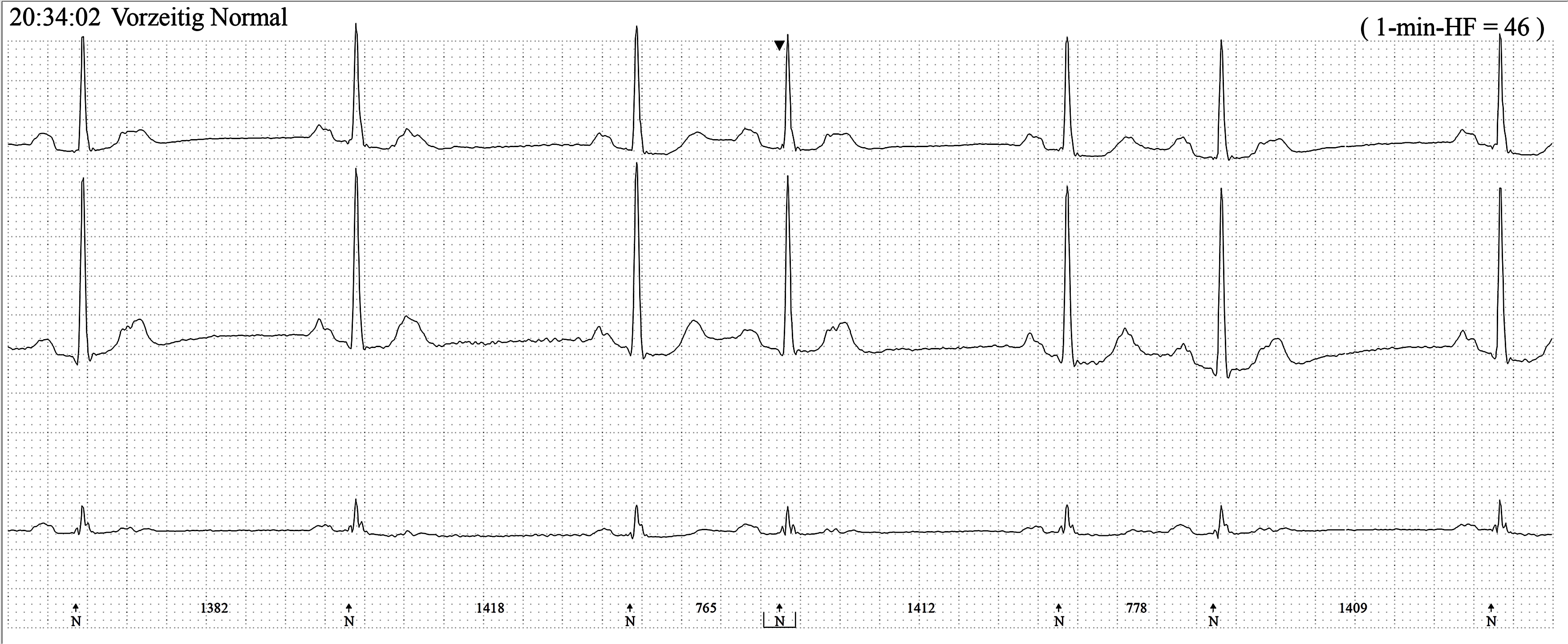 Blocked PACs ECG Guru Instructor Resources